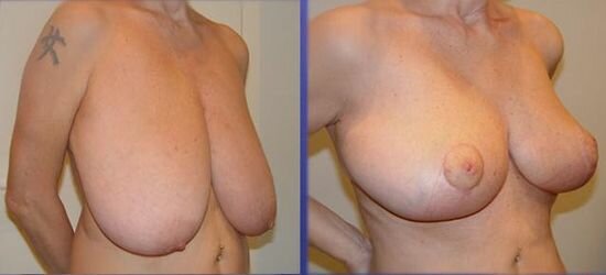Фото до і після мастопексії
