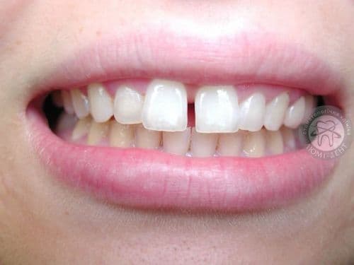 Щілина між зубами: косметичний дефект або патологія