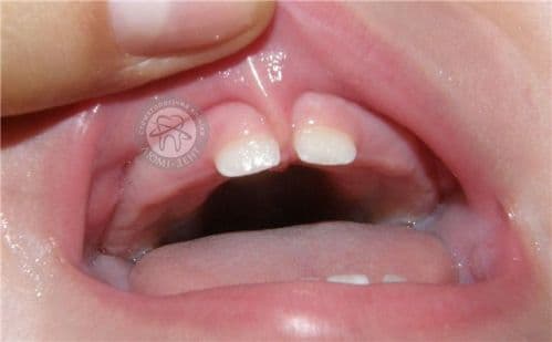 Хірургічна пластика вуздечки губ