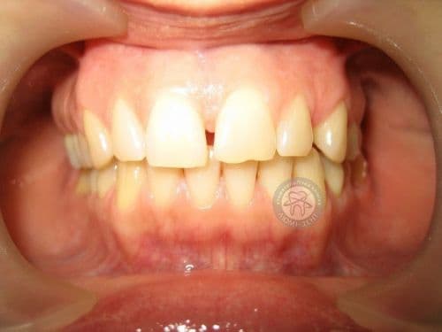 Прибрати щілину між передніми зубами в даній ситуації можна тільки за допомогою професійного стоматолога