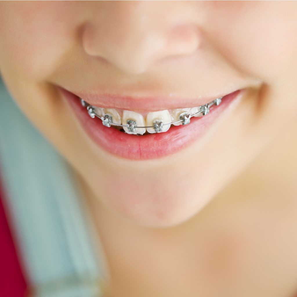 Крім того, здорові зуби, зі збереженими нервами, без імплантів або протезів, будуть вирівняні швидше