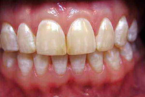 Красива посмішка складається з двох компонентів: рівні зуби і білі зуби