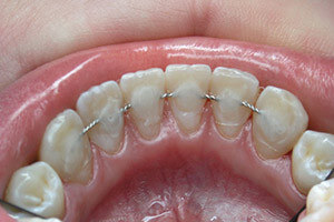 Порядок проведення відбілювання і ортодонтичного лікування