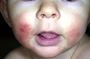 Висип навколо рота у дитини може свідчити про наявність алергії