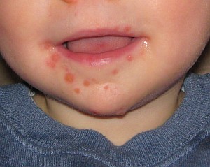 ентеровірусна інфекція   є ще однією причиною висипань навколо рота у дитини