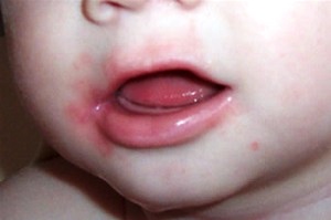 У самих маленьких дітей при прорізуванні зубів спостерігається рясна слинотеча