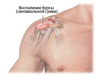 Одна з найбільш частих причин появи болів в плечі при відведенні руки назад - це бурсит