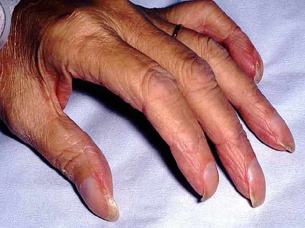 Проблеми з руками можуть свідчити про низку важких захворювань