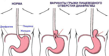 змінна - коли в грудну порожнину виходить ділянку, де стравохід переходить в шлунок, і фрагмент самого шлунка;   параезофагальная - стравохідно-шлунковий перехід залишається в черевній порожнині, але частина шлунка проникає через стравохідний отвір і знаходиться вище діафрагми