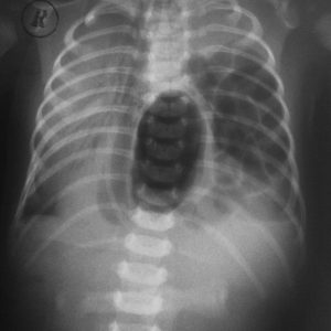 Рентгенографія з використанням контрастної речовини - найбільш показовий метод в діагностиці діафрагмальної грижі