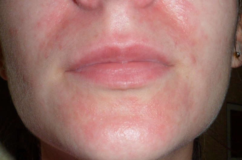 Це захворювання починається з того, що раптово навколо рота проявляється роздратування шкіри у вигляді дрібної червоної висипки
