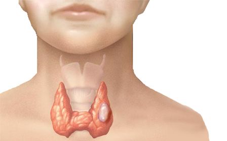 Щитовидна залоза - орган ендокринної системи, розташований на передній поверхні шиї