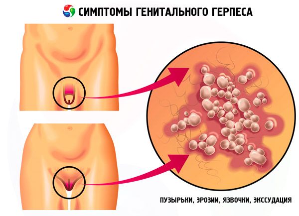 Генітальний герпес у жінок і чоловіків найчастіше є наслідком зараження вірусом герпесу людини (ВГЧ) 2 типу, хоча в деяких випадках це захворювання ВГЧ 1 типу