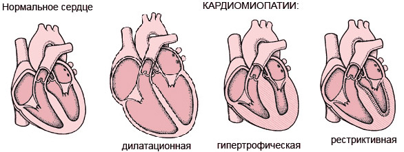 Дилатаційна кардіоміопатія - переважання   дилатації камер серця   над   гіпертрофією міокарда   , Зниження скоротливості міокарда і прогресування   серцевої недостатності   , Стійкої до лікування