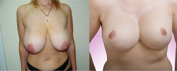 знижується ризик ускладнень;   не залишається ніяких видимих ​​шрамів;   зберігається ефект «підтягування» грудей і шкіри